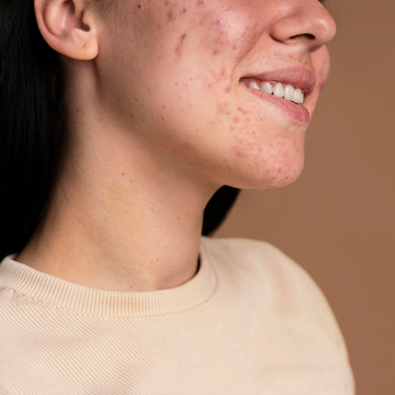 Akne & Rosacea