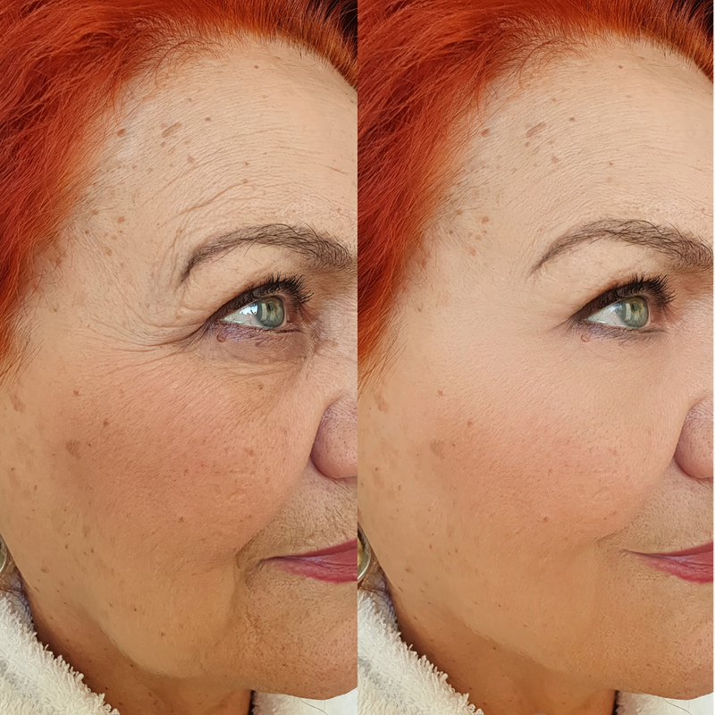 Vorher–Nachher-Ergebnis