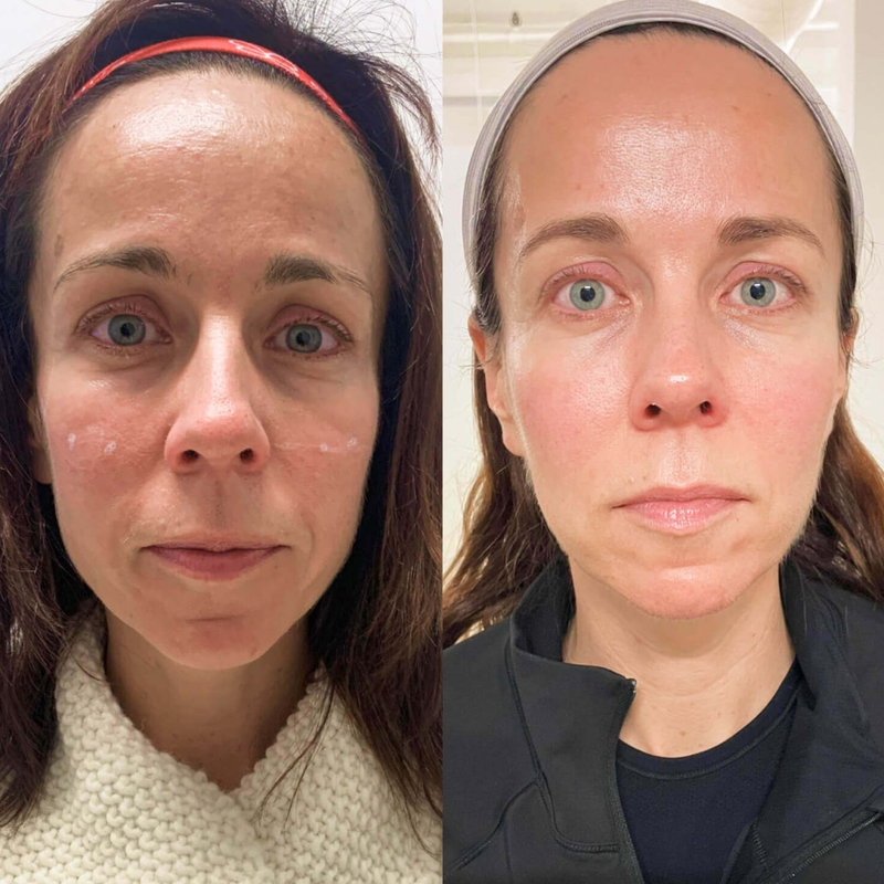 Vorher–Nachher-Ergebnis